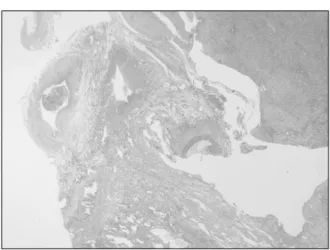 Fig.  3.  The  resected  portion  of  the  liver  reveals  a  relatively  smaller  portal  vein  than  the  hepatic  artery  at  the  hilar  portion  (H&amp;E,  ×10)
