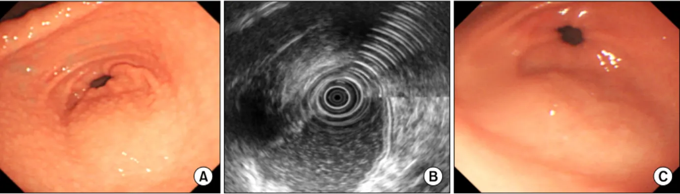 Fig.  1.  (A)  Endoscopic  finding  of  the  antrum  shows  diffuse  carpet-like  mucosal  nodularity