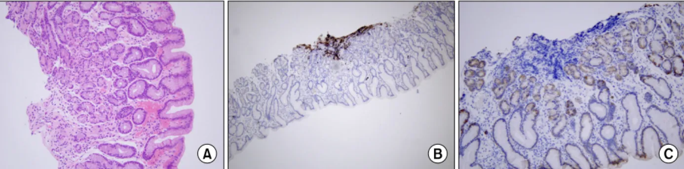 Fig.  3.  (A)  After  eradication  of  H.  pylori ,  microscopic  finding  shows  reactive  lymphocytes  without  lymphoepithelial  lesion  (H&amp;E  stain,  ×200)