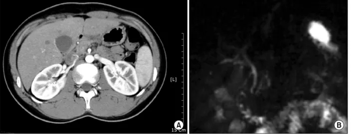 Fig.  1.  Abdominal  CT  (A),  MRCP  (B)  shows  normal  common  bile  duct  and  pancreatic  duct  without  pancreatic  ductal  anomalies.