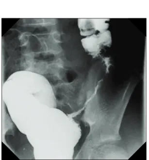 Fig.  1.  Colon  study  shows  the  narrowing  lumen  by  mass  in  distal  descending  and  sigmoid  colon.