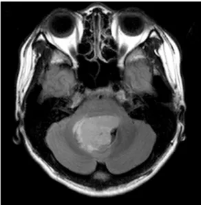 Fig.  1.  Brain  MRI  shows  heterogeneous  enhancing  mass  in  the  4th  ventricle.
