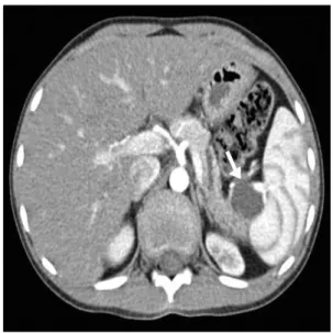 Fig.  3.  ERCP  shows  segmental  irregular  narrowing  of  the  main pancreatic  duct  in  the  pancreas  tail.