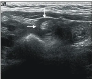 Fig.  1.  Abdominal  ultrasonography  shows  a  doughnut  sign  on  transverse  scan  indicating  intussusception