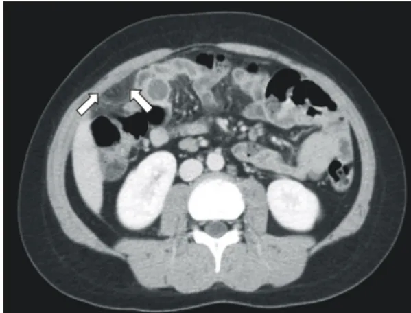 Fig.  1.  Abdominal  Utrasonography  shows  ovoid  hyper- hyper-echoic  mass  on  right  lower  quadrant  area.