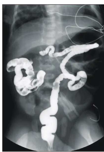 Fig.  3.  Photographs  show  meconium  plugs  evacuated  during  explolatory  laparotomy  of  case  1  (A)  and  multiple  fragmented  plugs  evacuated  by  gastrografin  enema  of  case  3  (B).