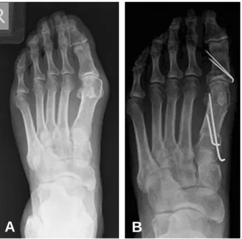 Figure 1. (A) Preoperative plain radiograph of group A (B) Final follow-up plain radiograph of group A