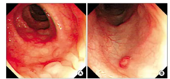Fig.  1.  Colonoscopic  finding  shows  nodular  hyperplasia  with  surrounding  hemorrhagic  spots  in  the  rectosigmoid  colon  (A,  B)