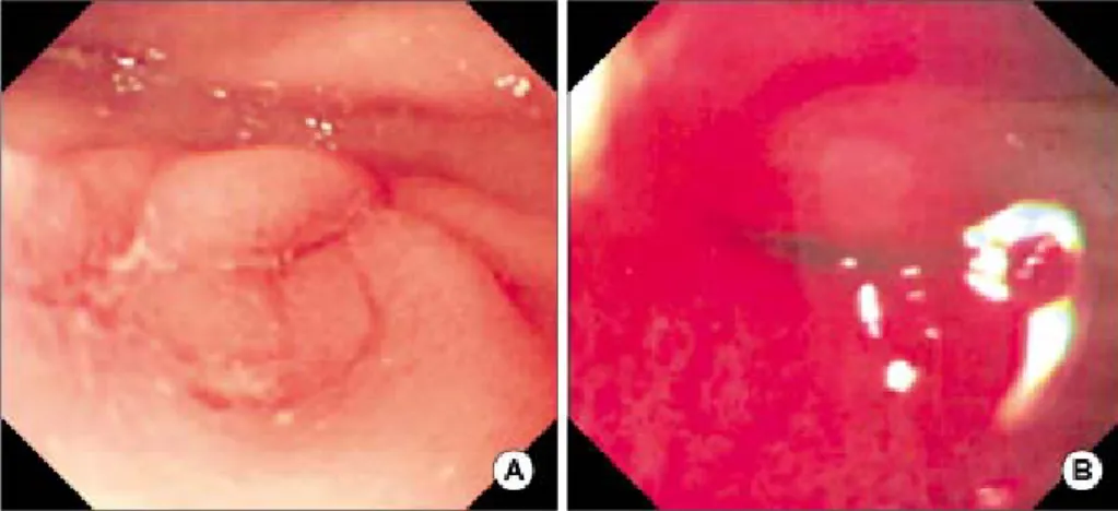 Fig.  2.  Follow-up  of  gastrofiberoscopy  showed  healed  ulcer  of  antrum  (A)  but  slit  like  pyloric  opening  due  to  outlet  obstruction  (B)  1  week  later.