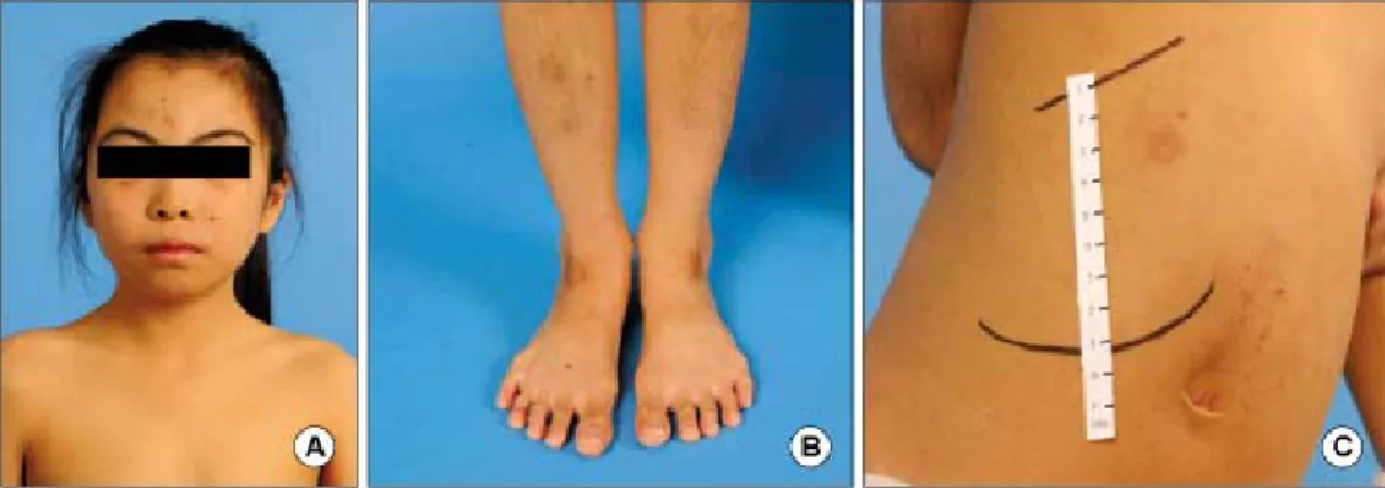 Fig.  1.  Pedigree  of  the  patient’s  family.  Solid  circle  and  square  indicate  the  patient  with  photosensitivity