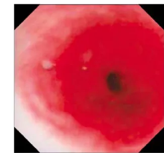 Fig.  4.  Four  weeks  later,  follow  up  endoscopic  finding  shows  disappearance  of  ulcers  and  white  plaques.