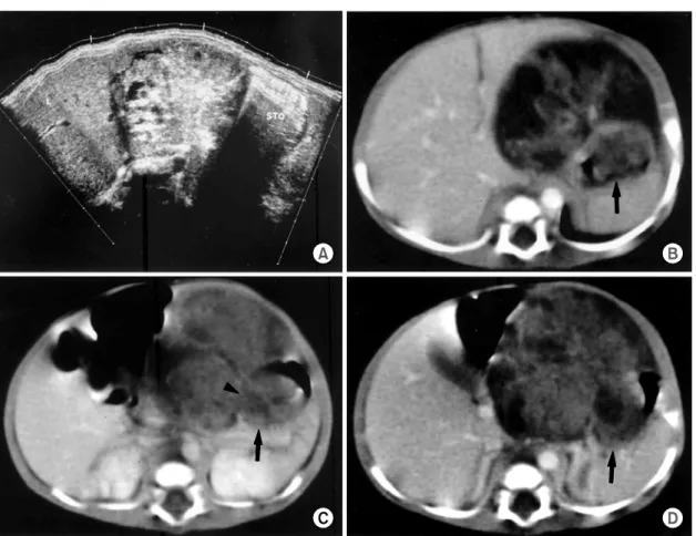 Fig.  3.  A.  Gross  finding  of  the  tumor  shows  a  solid  mass  with  irregular  and  nodular  surface  measuring  6×7  cm  in  diameter  at  the  body  of  the  stomach