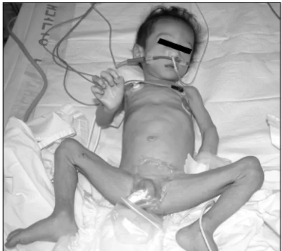 Fig.  2.  General  appearance  of  the  patient  shows  severe  emaciation  and  failure  to  thrive.