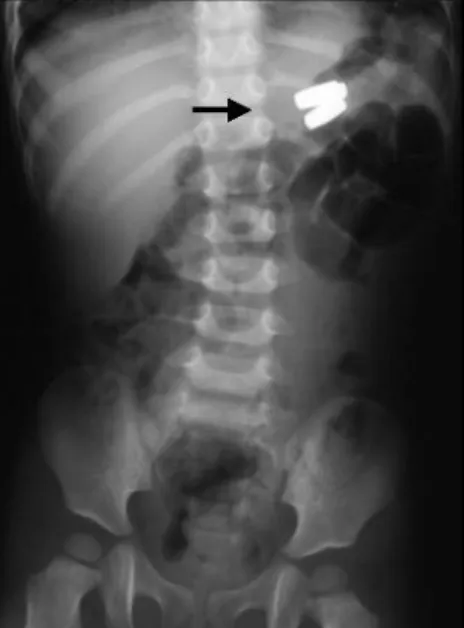 Fig.  3.  After  removal  of  magnets  in  the  stomach,  a  deep  ulceration  was  noted  (arrow).
