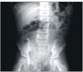 Fig.  4.  Upright  abdominal  simple  X-ray  film  finding  on  the  50  th  day  of  illness  shows  completely  normal  gas  pattern  of  stomach,  small  and  large  bowels.
