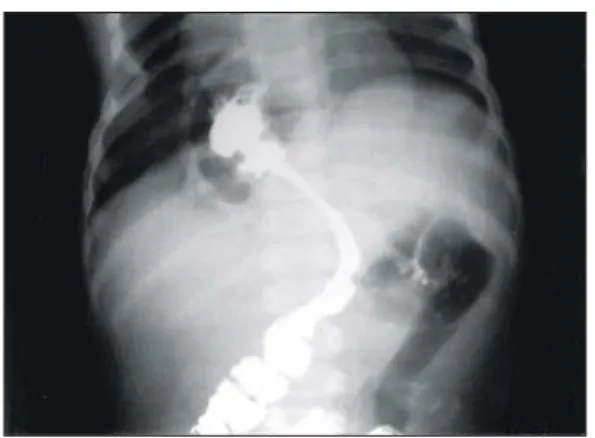 Fig.  2.  Small  bowel  series  (delayed  120  minutes):  The  hepatic  flexure  of  colon  is  seen  interposed  between  the  liver  and  right  hemidiaphragm.