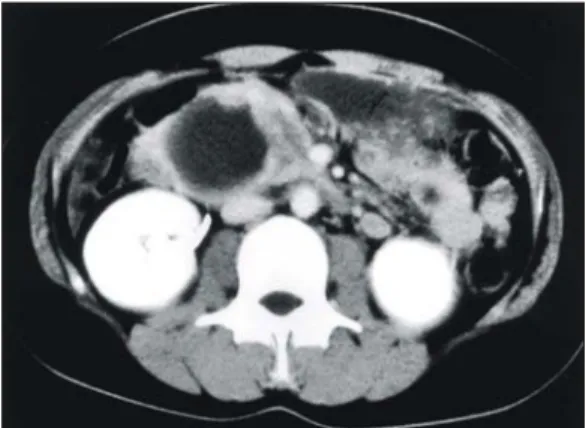 Fig.  2.  Abdominal  CT  scan  shows  multiple  variable-  sized  hypodense  masses  in  the  liver.