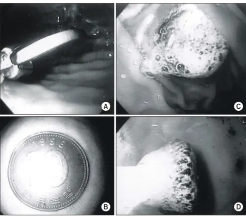 Fig.  1.  Endoscopic  removal  of  foreign  bodies:  A  coin  was  removed  with  a  grasping  forcep  (A,  B),  and  a  button  battery  with  a  net  (C,  D).