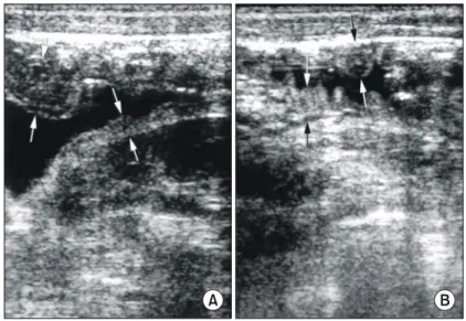 Fig.  1.  Transverse  ultrasonogram  of  the  abdomen  demonstrated  the  thickened  bowel  wall  (arrows)  of  the  duodenum  (A)  and  the  proximal  jejunum  (B).