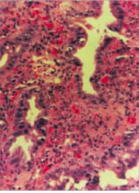 Fig.  3.  Photomicrograph  showed  acute  inflammatory  infiltrates  in  the  mucosa  with  congestion  and   hemor-rhage  (H&amp;E,  ×100).