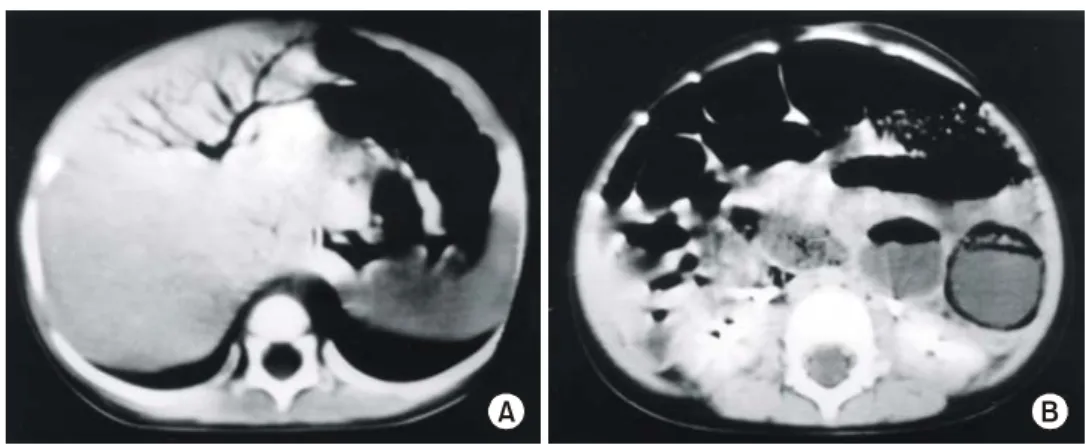Fig.  2.  Simple  abdominal  X-ray  reveals  dilated  bowel  loops.