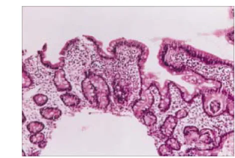 Fig.  2.  High  power  view  shows  infiltration  of  eosinophils  and  lymphoplasma  cells  in  edematous  lamina  propria  (H-E,  ×200).