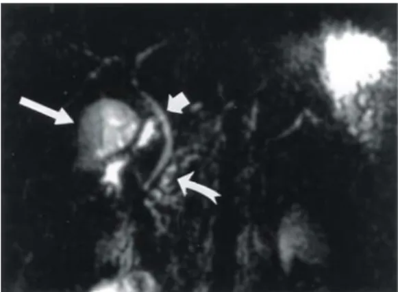 Fig.  1.  MRCP  shows  gallbladder  (thin  white  arrow),  common  bile  duct(thick  white  arrow)  and  pancreatic  duct  with  multiple  stones  (curved  arrow).