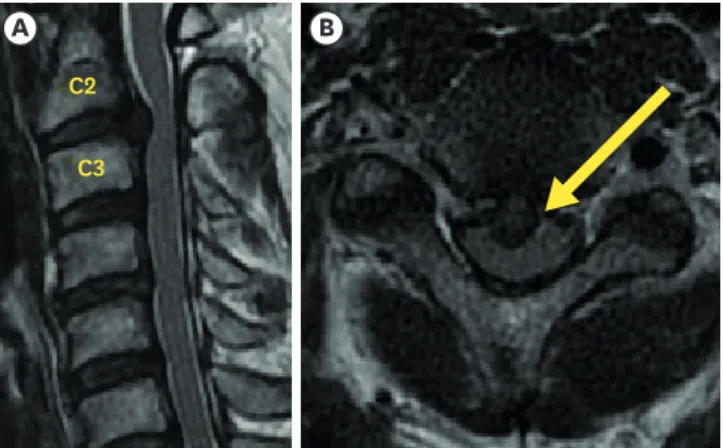 FIGURE 1. Sagittal (A) and axial (B) magnetic resonance images acquired before operation show central disc  protrusion and spinal cord compression.