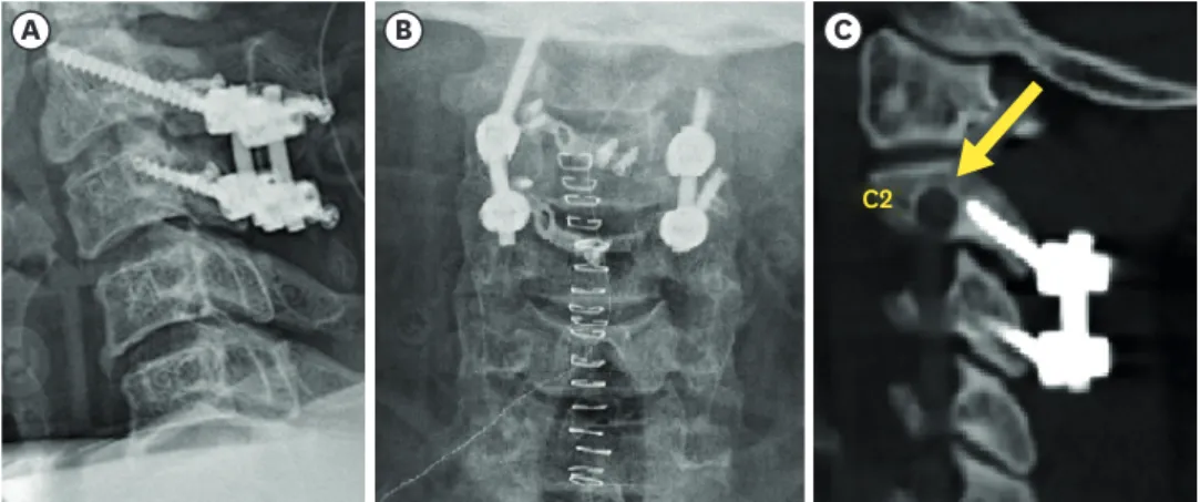 FIGURE 3. Radiography shows safe insertion of the C2–3 pars and pedicle screw (A, B), and postoperative  computed tomography angiography shows no injury of the left vertebral artery (arrow, C).