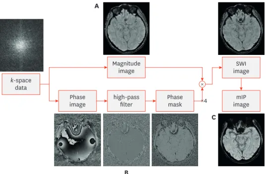 FIGURE 1. Acquisition and post-processing of susceptibility weighted imaging. (A) Magnitude image, acquisition  of T2 * -weighted sequence to enhance the visibility of susceptibility differences using high-resolution  three-dimensional gradient echo
