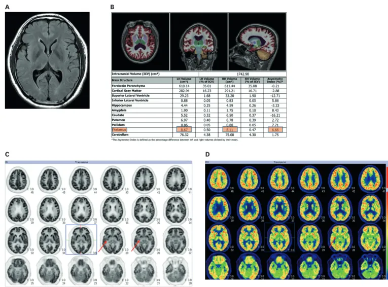 FIGURE 7. Volume segmentation and analysis through computer automated brain volume analysis software (NeuroQuant, an Food and Drug Administration- Administration-cleared method for measuring brain magnetic resonance volume) and PET-CT image in a 44-year-ol