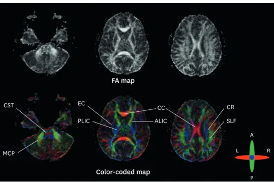 FIGURE 8. Diffusion tensor imaging parameter: FA map and color-coded map. On FA map, CC or CST demonstrate  high FA value, with high directionality