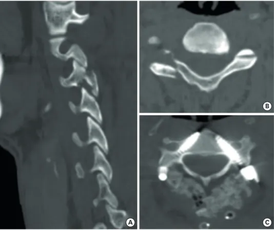 FIGURE 1. CPS fixation in patient with fractured lateral mass of right C3. (A) Sagittal image of preoperative CT scan  shows fractured inferior articular process of right C3
