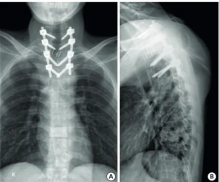 FIGURE 4. Advantage of pedicle screw for the stabilization of cervicothoracic junction pathology