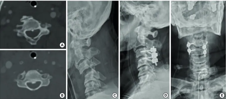 FIGURE 5. Conversion to lateral mass screw because of unilaterally dominant vertebral artery