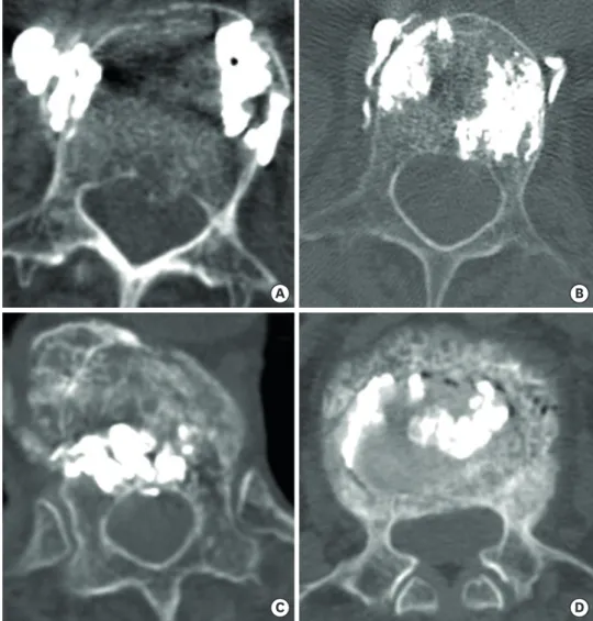 FIGURE 3. Cement leakage classification. (A) Leak into the paravertebral muscle and soft tissue, (B) leakage into  the paravertebral vein, (C) leakage into the disc space, (D) leakage into the spinal canal.