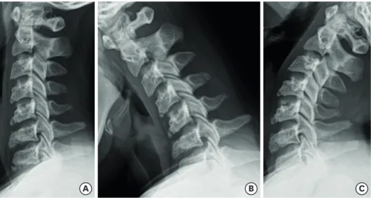 FIGURE 1. Initial C-spine (A) neutral, (B) flexion and (C) extension lateral views. Anterior-wedge deformed vertebral  bodies with endplate irregularities and osteophytes at C4 to C7 are shown