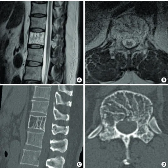 FIGURE 1. (A, B) T2-weighted sagittal and axial magnetic resonance images demonstrate a hyperintense signal on  T12 body, with thickened trabeculae indicating the presence of typical vertebral hemangioma not compressing  the spinal cord