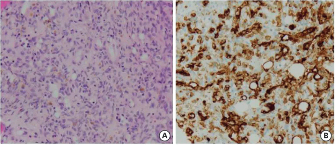 FIGURE 4. Histopathologic images obtained during surgery. (A) The images demonstrate the proliferation  of epithelioid cells and well-formed capillary-sized blood vessels