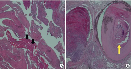 FIGURE 3. Histopathologic examination shows multiple vascular spaces lined by endothelial cells (black arrows)  with striated mf (A, H&amp;E stain, ×40)