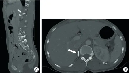 FIGURE 2. A thoracolumbar spine computerized tomography scan showed a linear acicular structure with high  density in the right retroperitoneal space (white arrows)