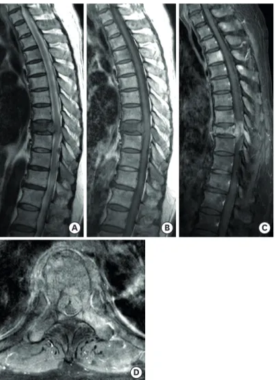 FIGURE 1. Preoperative T-spine magnetic resonance imaging. (A) T2 sagittal, (B) T1 sagittal, (C, D) T1 enhance  sagittal and axial images