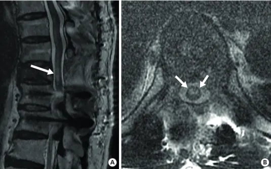 FIGURE 3. Postoperative magnetic resonance imaging taken at one day post-surgery. (A) T2 sagittal and (B) T2  axial images
