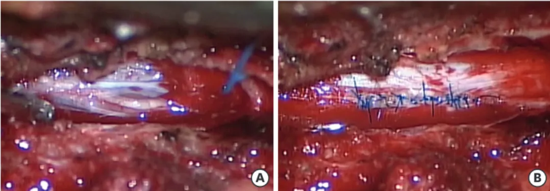 FIGURE 3. Intraoperative findings of the patient after cyst removal. A communicating tract and approximately  3 cm of dural defects with herniated nerve rootlets are observed (A)