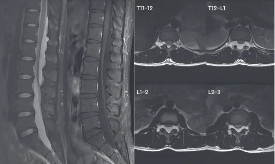 FIGURE 1. A spinal epidural arachnoid cyst locates from T11 to L3, along with thecal sac compression.