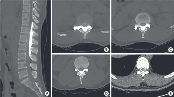 FIGURE 3. Post cystography computed shows that contrast has spread into the subarachnoid space, indicating the presence of a dural defect site.
