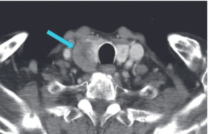 Fig. 1. Computed tomography scan revealed a 3.4 cm heterogenous enhancing tumor with calcification in right  thyroid gland.