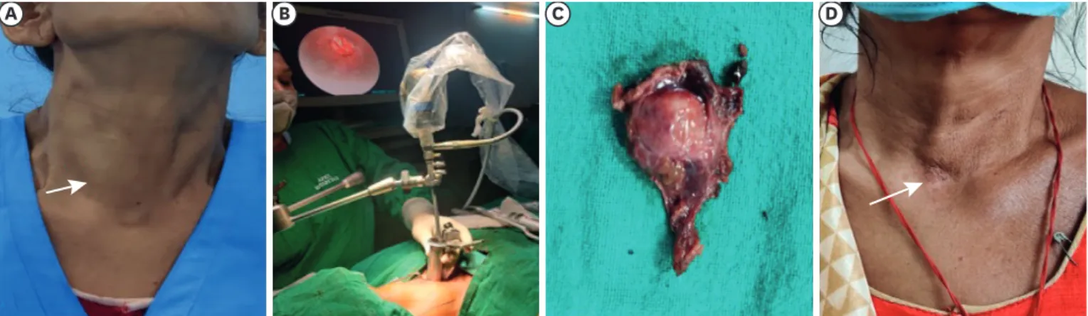 Fig. 2. (A) Right benign euthyroid solitary thyroid nodule, (B) set up for hemithyroidectomy using tubular retractor, (C) excised nodule, (D) scar mark at 3  months follow-up.