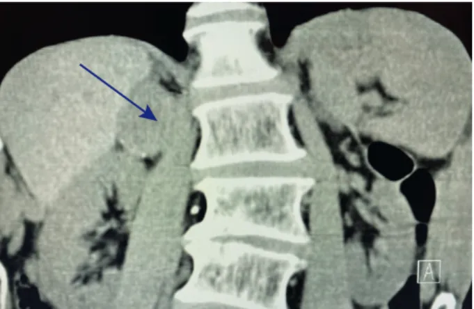 Fig. 2. Computed tomography scan axial view of the right adrenal lesion. Arrow depicts the lesion.