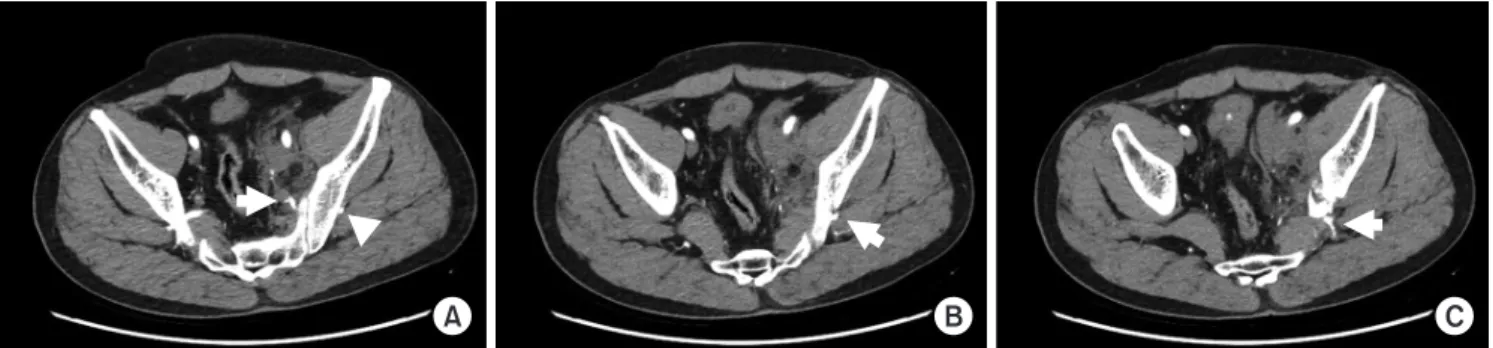 Fig. 2. Serial cut of contrast-enhanced pelvic computed tomography (CE-CT). (A) Arterial phase of CE-CT shows the proximal portion (arrow) and  distal portion (arrowhead) of the superior gluteal artery above the sciatic notch